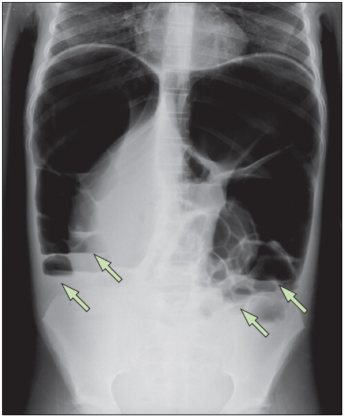 立体腹部平片示结肠大量扩张伴有少数气液平面(箭头所示)