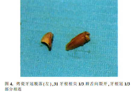 锥形束ct诊断左下中切牙不典型性牙根纵折1例