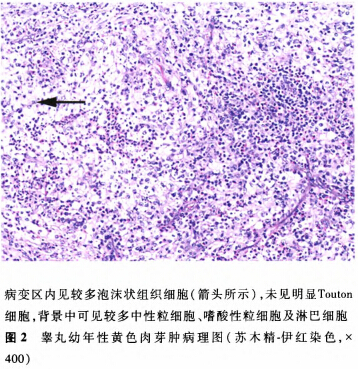 睾丸幼年性黄色肉芽肿一例