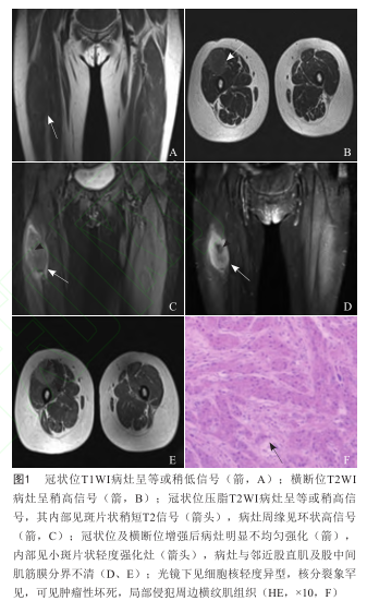 右大腿股外侧肌内非典型颗粒细胞瘤
