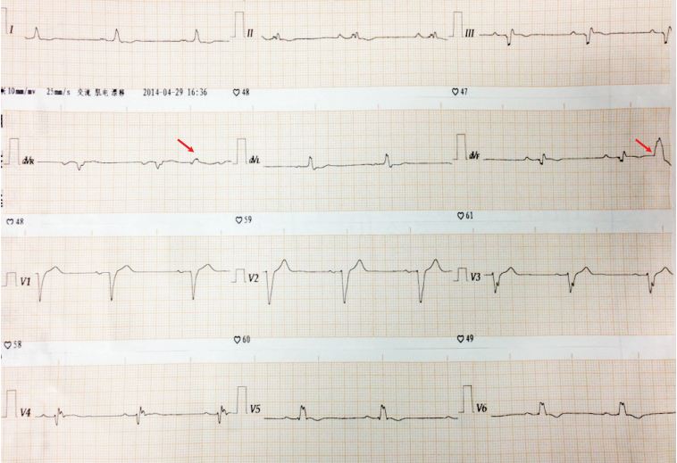 前壁心肌梗死出现室性早搏,有ront现象b.前壁心肌梗死发.