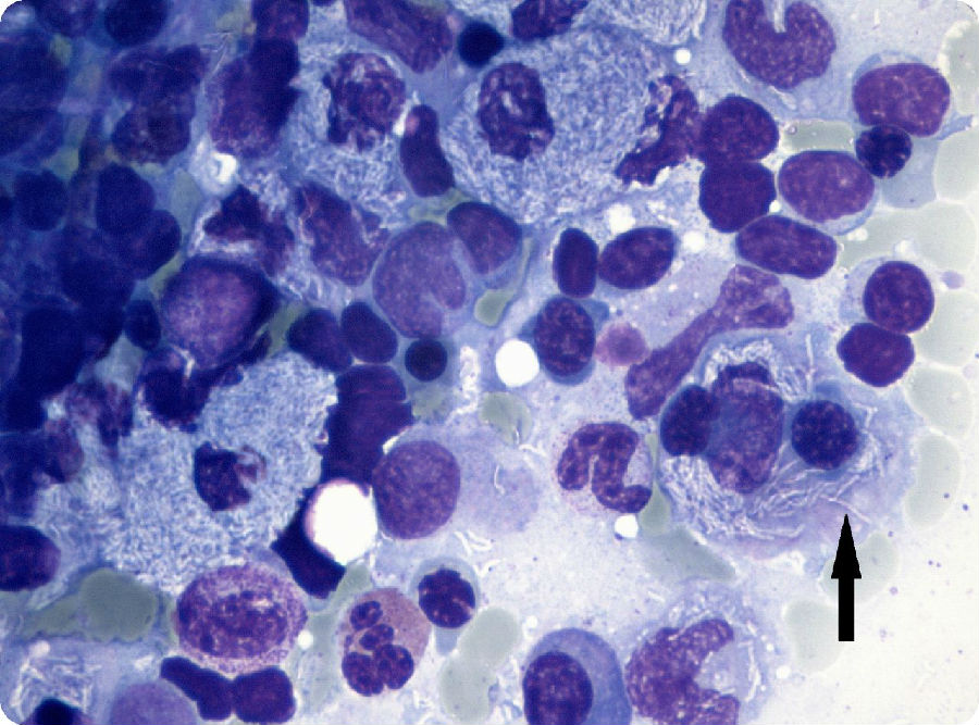 经典病例_“非典型”巨噬细胞_医脉通