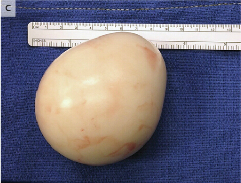 腹腔内游离体1例
