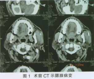 医学新闻 正文    腮腺横断ct检查:左侧腮腺形态较对侧增大,考虑为