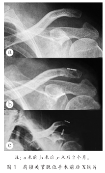 局部无红肿,隆起,肩关节活动度良好,x线片显示肩锁关节位置形态佳