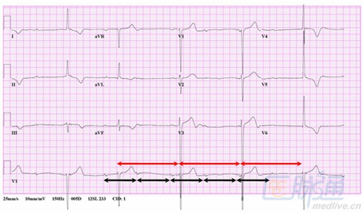 心电图要诊断的话,单独看一个波形是很难分析的.
