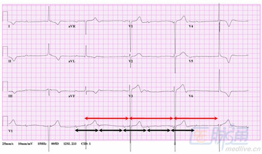 心电图的识别