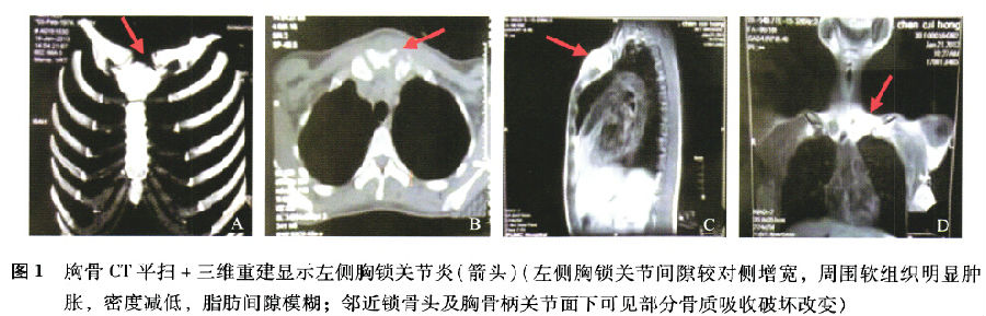 左侧锁骨头信号欠均匀,增强后胸锁关节周围病灶强化;左肺尖见斑片状