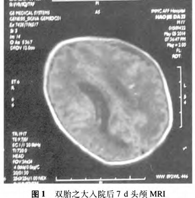 早产儿双胎同患先天性巨细胞病毒感染