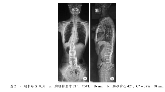 长节段脊柱-骨盆固定治疗帕金森病伴神经肌源性胸腰椎