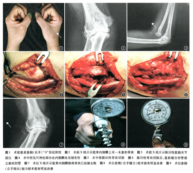 陈旧性肱桡关节脱位致肘管综合征一例