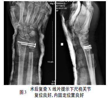 sauvé-kapandji术治疗陈旧性下尺桡关节掌侧脱位1例