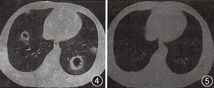 【转帖】疑难病例讨论:间断出现肺部空洞4年