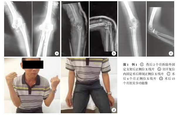 肘关节骨折术后的康复训练