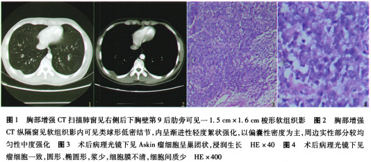 胸部外科讨论版 69 胸壁askin瘤1例  2013年12月行右胸壁肿瘤切除术