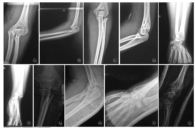手法复位治疗桡骨头骨折合并下尺桡关节脱位并肘关节脱位1例