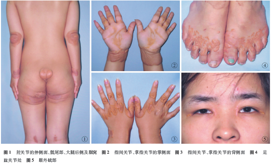 经典病例_家族性高胆固醇血症黄瘤病一例