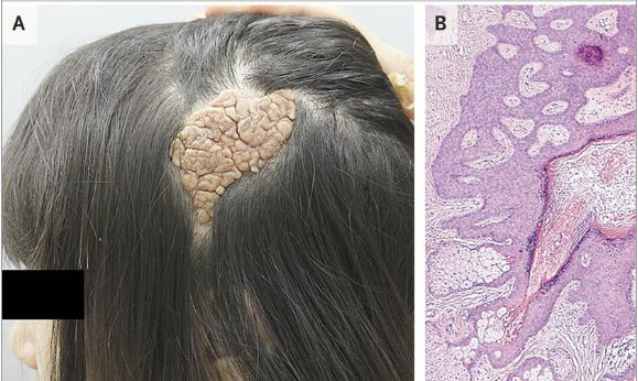 nejm:髓状皮脂腺痣病例报道