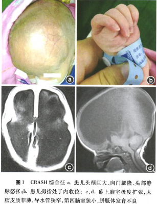 头皮静脉怒张,囟门明显增大(约7 cm),冠状缝,矢状缝,人字缝均出现严重
