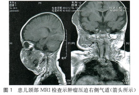 卡波西样血管内皮瘤一例