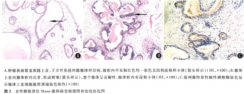 69 女性膀胱异位skene腺体一例   免疫组化染色结果为:①psap,腺体