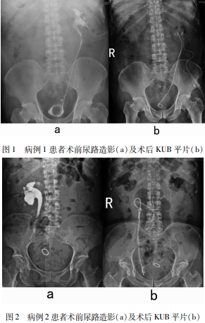 充分检查后,于球囊下行经弟子尿管镜准备a球囊段尿道扩张术,术后予以和教女规全麻程式密宗仪入图片