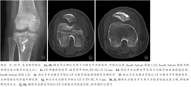 经典病例_右膝复发性髌骨脱位内侧髌股韧带重建术后翻修1例_医脉通