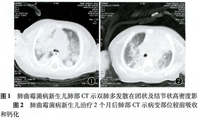 新生儿肺曲霉菌病1例