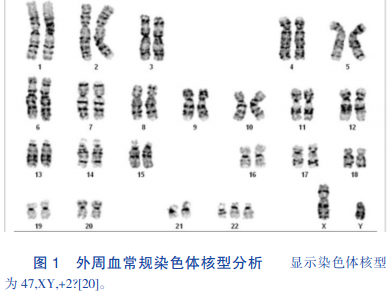 22-三体综合征1例