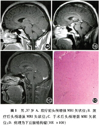 灰结节错构瘤