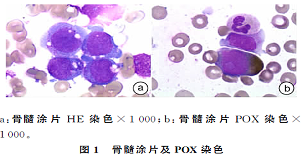 髓系 nk细胞急性白血病一例