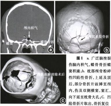 后颅窝多发骨折骑跨血肿,鼻漏抢救成功一例