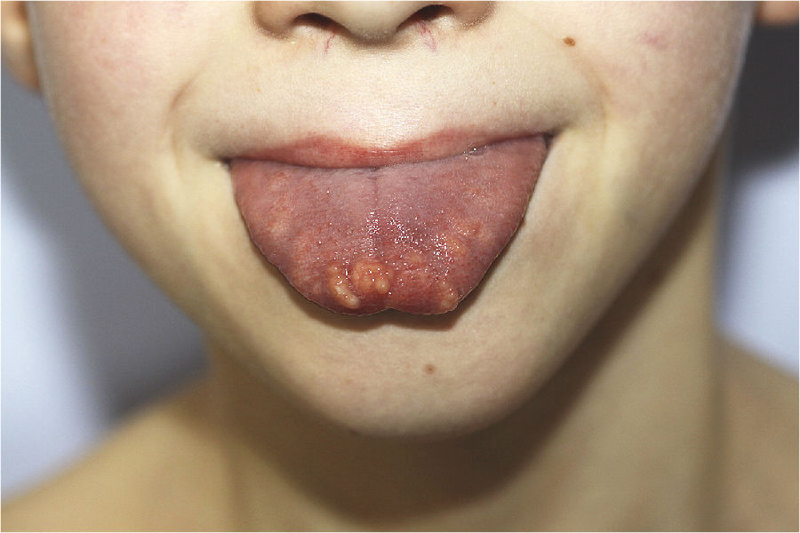 舌上丘疹,原来是黏膜神经瘤?