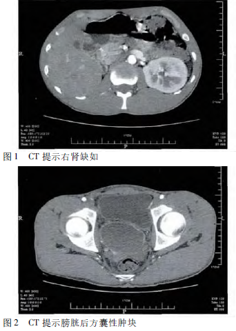 苗勒管囊肿伴右肾缺如1例