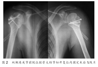 电击伤致双肩脱位伴肱骨大结节骨折病例分析及相关