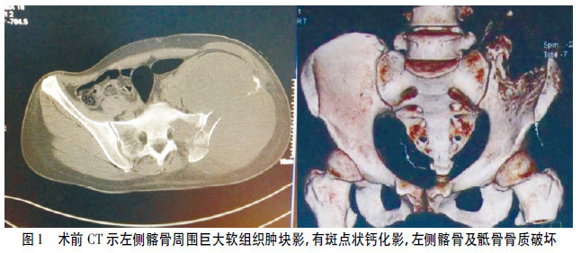 骨盆巨大原始神经外胚层肿瘤1例报告并文献复习