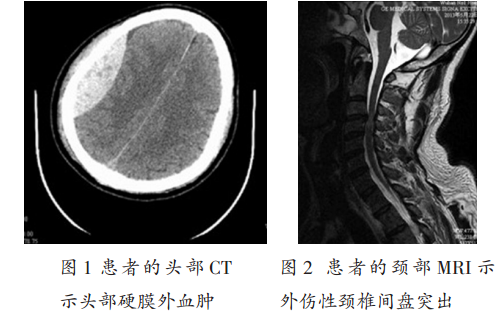 急性硬膜外血肿最常见的伴随损伤是 a.脑挫伤b.脑疝c.