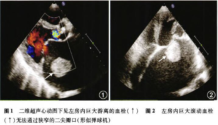经胸超声心动图评价左心耳封堵术对猪左心房功能及二尖瓣,肺静脉血流