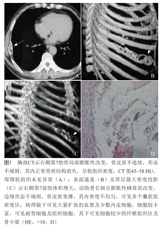 骨囊肿的病理病因