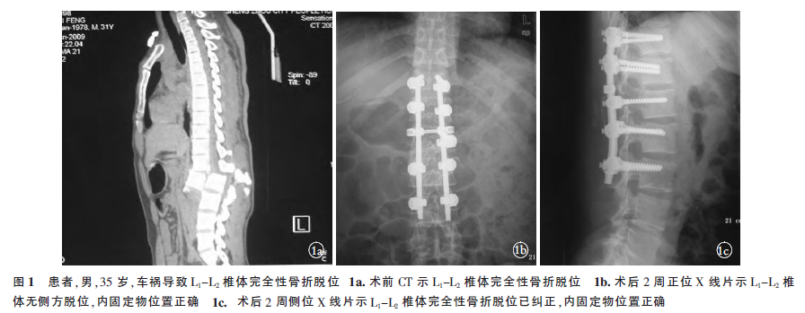 l1-l2椎体完全性脱位伴椎体间重叠1例