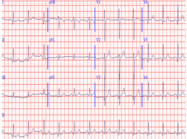儿童心电图:良性变异or异常表现?(一)