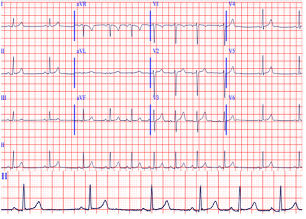 儿童心电图:良性变异or异常表现(一)