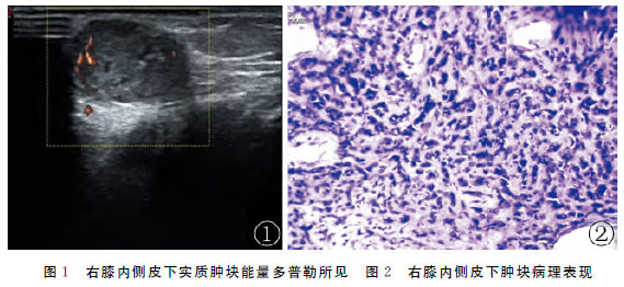 超声诊断骨外软骨肉瘤1例