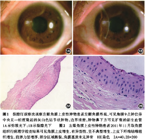 复发性角膜上皮不典型增生一例