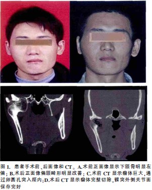 髁突巨大骨软骨瘤手术切除1例