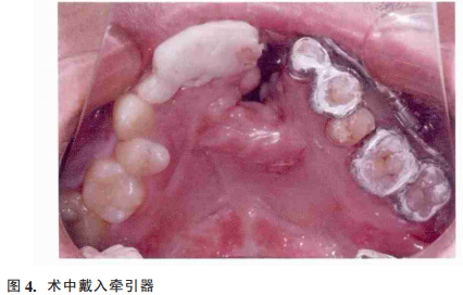 应用牙间牵引成骨辅助唇腭裂牙槽植骨术前治疗1例报告