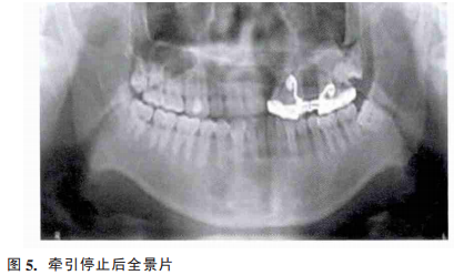 应用牙间牵引成骨辅助唇腭裂牙槽植骨术前治疗1例报告