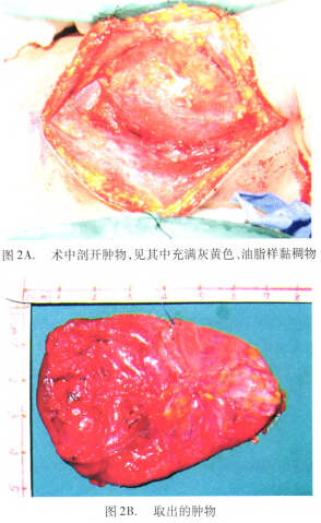 本文病例属于第二鳃裂囊肿.