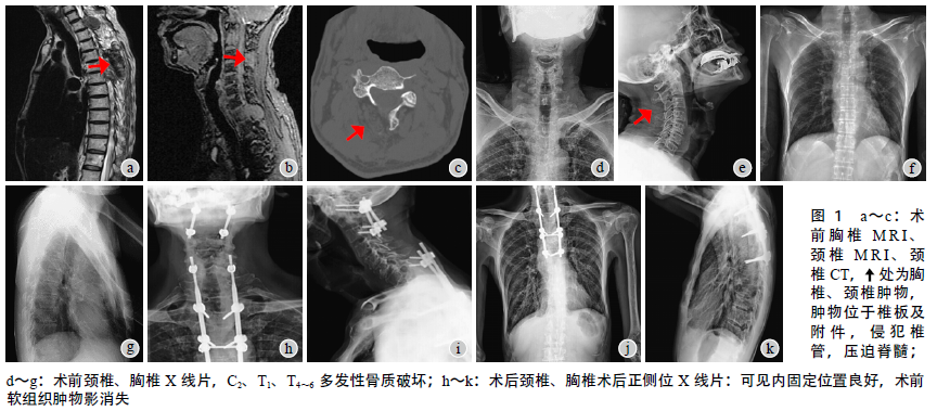 脊柱多发硬化性上皮样纤维肉瘤一例