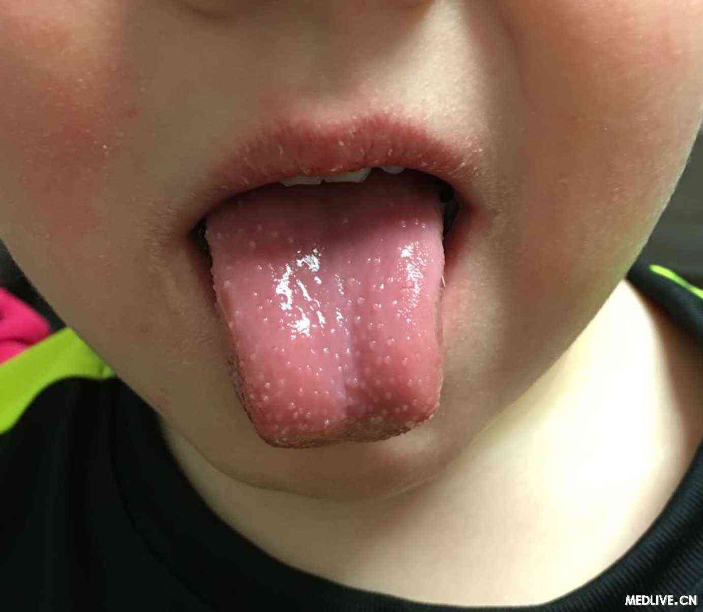 患者,发烧,裂痕唇,脸上有干疹,舌头呈现出如图所示额症状,可.